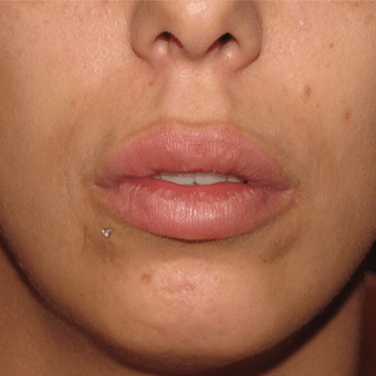 After Image: Lip Augmentation - front