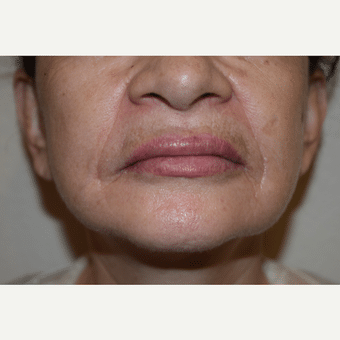 After Image: Lip Augmentation - front