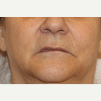 Before Image: Lip Augmentation - front