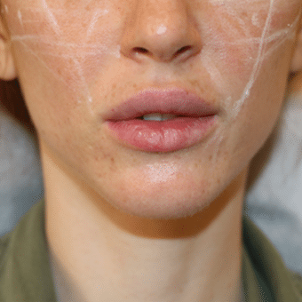 Before Image: Lip Augmentation - front