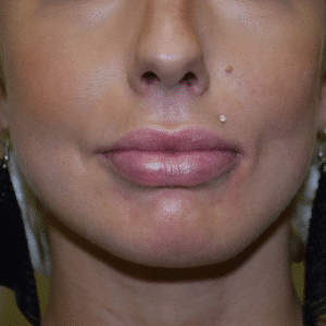 Before Image: Lip Augmentation