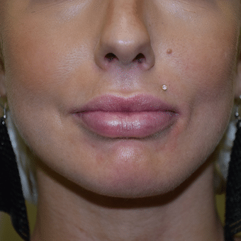 Before Image: Lip Augmentation - front