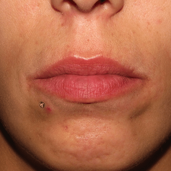 Before Image: Lip Augmentation - front