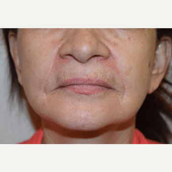 Before Image: Lip Augmentation - front