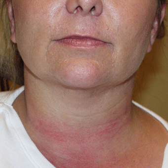 After Image: Liposculpture - front