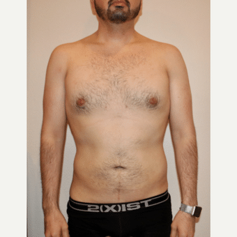 After Image: Liposculpture - front