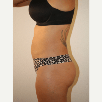 After Image: Liposculpture - left-side