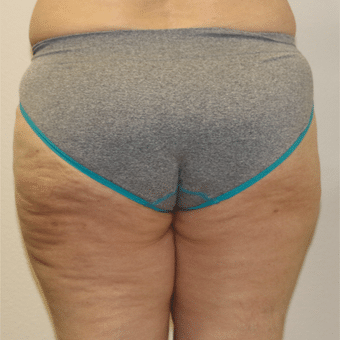 After Image: Liposculpture - back