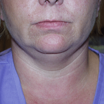 Before Image: Liposculpture - front