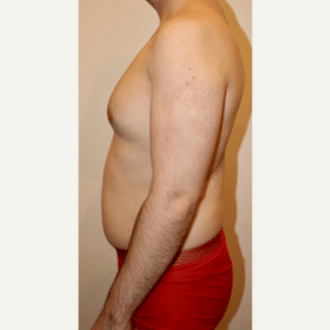 Before Image: Liposculpture