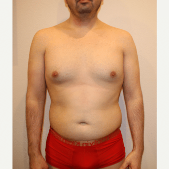 Before Image: Liposculpture - front