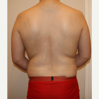 Before Image: Liposculpture - back