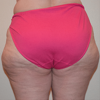Before Image: Liposculpture - back