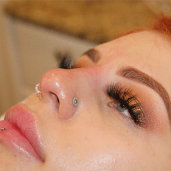 After Image: Nonsurgical Nose Job - left-front-oblique