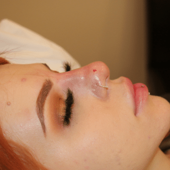 After Image: Nonsurgical Nose Job - right-front-oblique