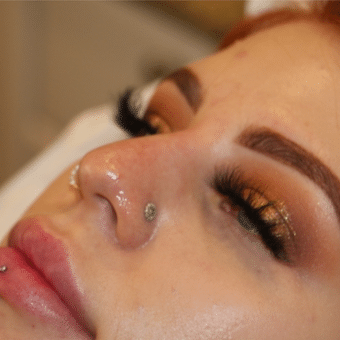 Before Image: Nonsurgical Nose Job - left-front-oblique