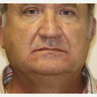 After Image: Restylane - front