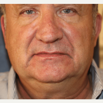Before Image: Restylane - front