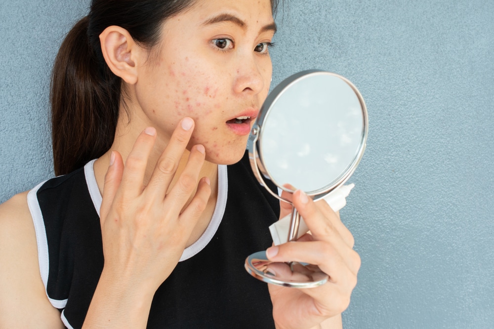 Young asian woman looking at her acne scars in a handheld mirror, in need of skin treatment.